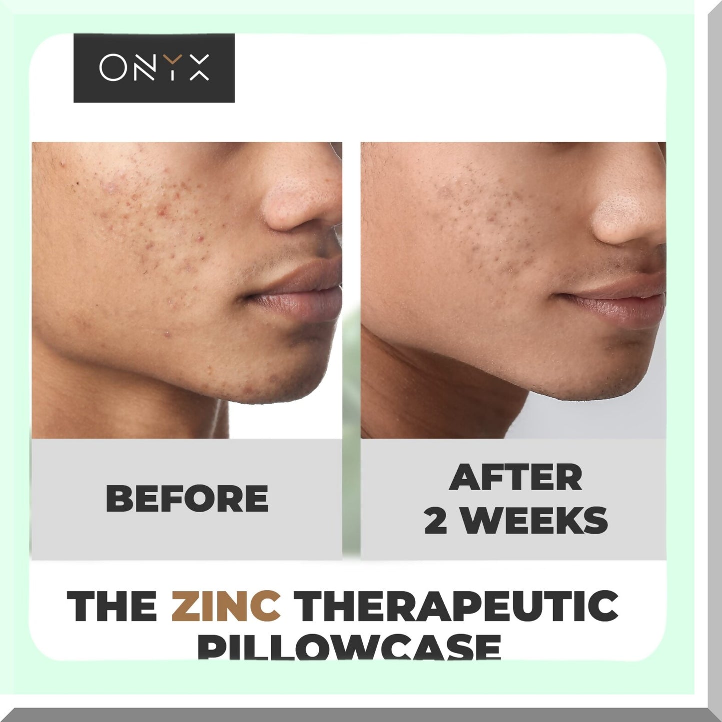 AcneShield Cotton Pillowcase - Zinc Infused Anti Acne Pillow Cover with Oeko-TEX Standard Fabric, Radiant White Soft Breathable Quality, 300 Thread Count